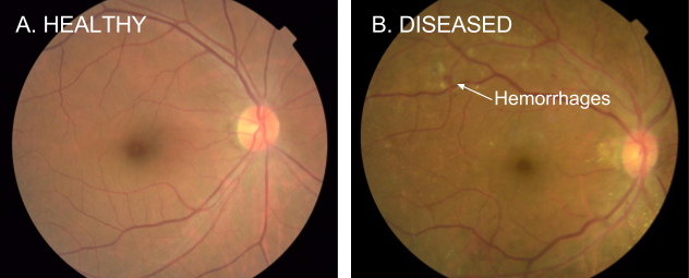 Ejemplos de imágenes de la retina en un sujeto sano (izquierda) y en un sujeto con retinopatía diabética (derecha). Créditos: ai.googleblog.com.