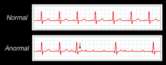 Electrocardiogramas de un sujeto normal (arriba) y de uno anormal (abajo)